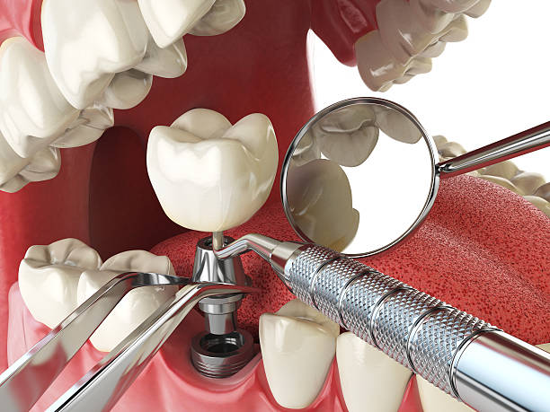 Best Broken or Chipped Tooth Repair in Warsaw, IL